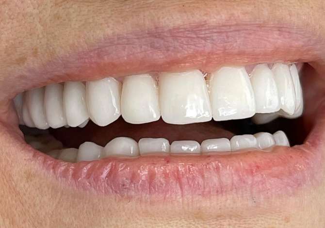 Klinika Dentare Begaj ofron sherbime per Implante, Ortodonti, Proteza, Konservative dhe Endo