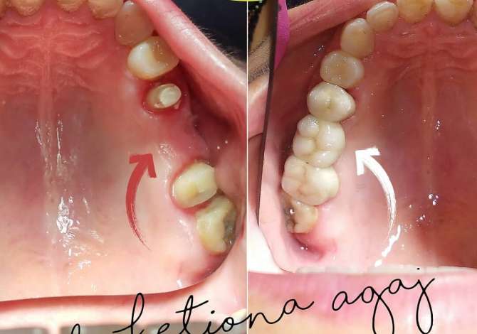 Klinika Dentare KetiDent ofron Mbushje estetike, Faseta dhe Buze, Zbardhim, Piercing, Fluorizim, Ura Porcelan dhe Zirkon etj.