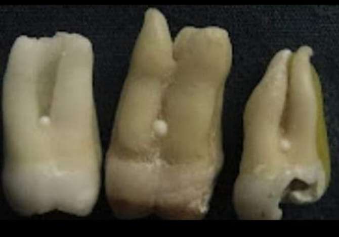 Klinike Dentare  Elodent ofron Heqje, Zbardhim, Implante, Konsulta dhe Vizita  nga mjeke te specializuar