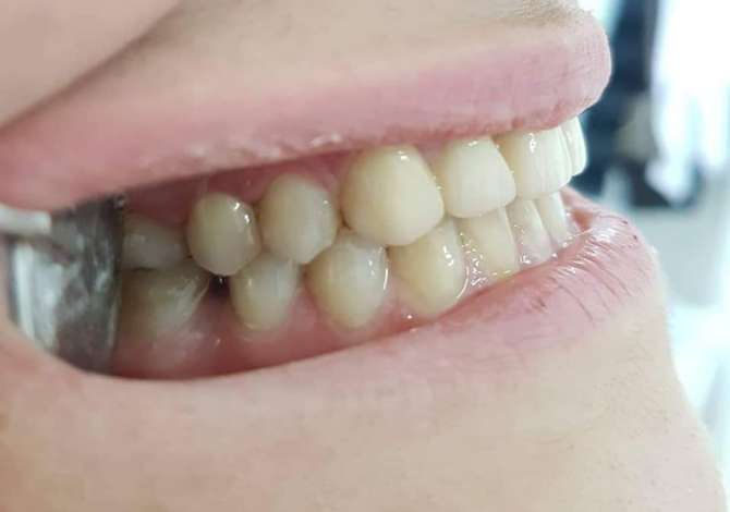 Klinika Dentare Parisi ofron sherbime si Heqje dhembi, Implante, Zbardhim etj.