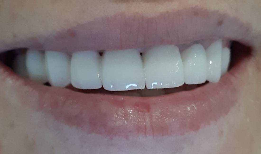 Klinika qe ju ofron sherbim cilesor ne Ure metal-porcelan, Heqje dhemballe, Drejtim i dhembeve me metoden e padukshme