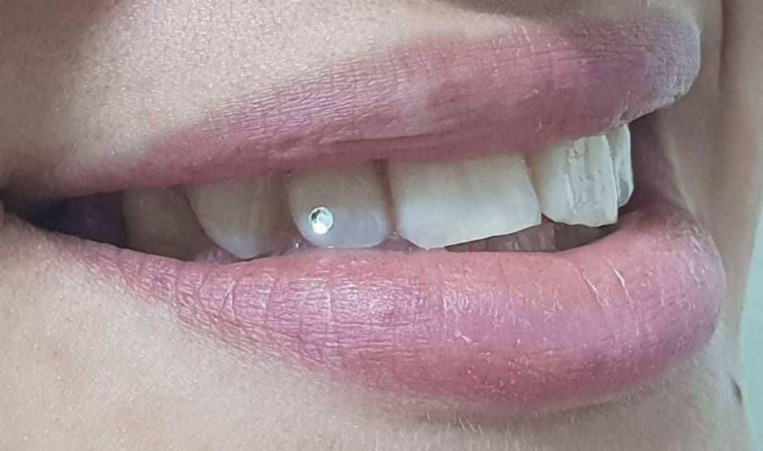 Klinike Dentare Prestige ofron Mbushje estetike Piercing, Estraksion dhemballe etj.