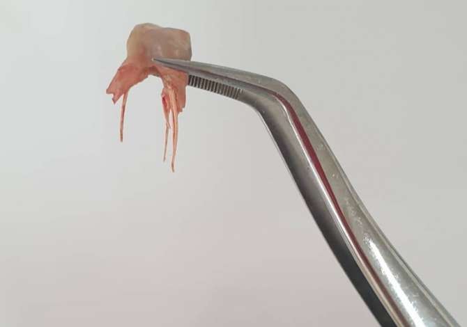 Klinike Dentare Prestige ofron Mbushje estetike Piercing, Estraksion dhemballe etj.