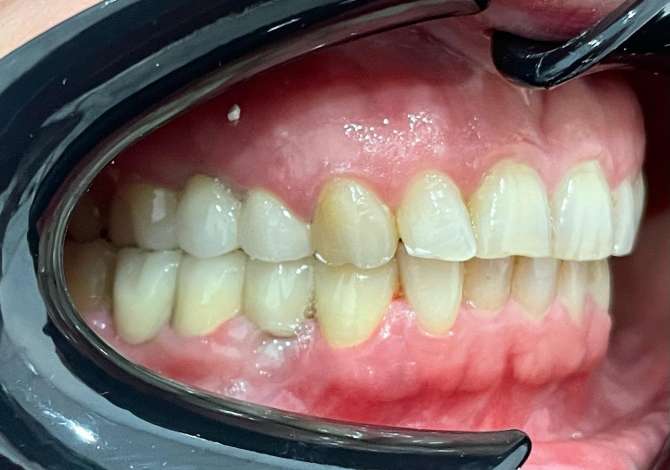 Klinike Dentare City Dent ofron sherbime per Heqje dhembi/dhemballe, Implante dhe Ura Zirkon dhe Porcelan