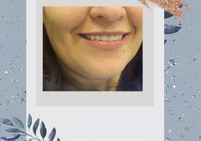 Klinike Dentare My Smile ofron sherbime per Heqje dhembi/dhemballe, Implante dhe Ura Zirkon dhe Porcelan