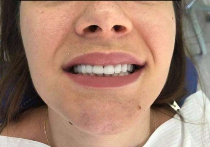 Klinika dentare Xholi ju ofron nje game sherbimesh cilesore per Mbushje, Impante, Zbardhim, Heqje etj.