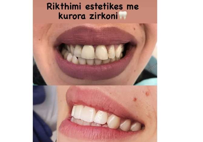 Klinika Dentare  kryen Pastrim, Zbardhim, Mbushje, Heqje, Implante, Ura fikse, Protza dhe Ortodontci