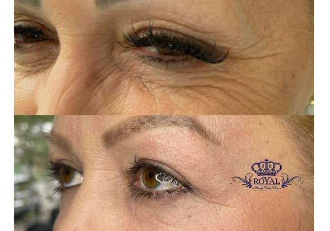 Klinike estetike e  specializuar per eleminim te rrudhave me aparaturen Fisiotron