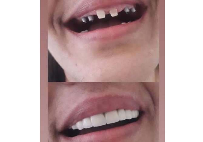 Klinike dentare e specializuar ne implantologji , porcela, zirkon, EMAX