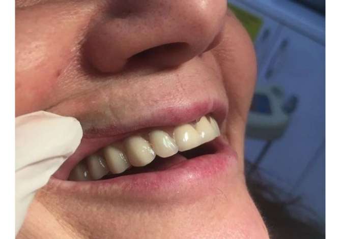 Klinike dentare e specializuar ne implantologji , porcela, zirkon, EMAX