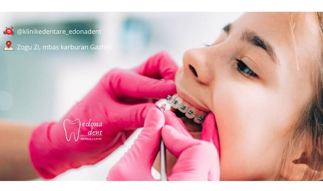 Klinike Dentare ofron sherbime per Aparate drejtimi, Zbardhim Profesional, E-max, Element zirkoni dhe Terapi