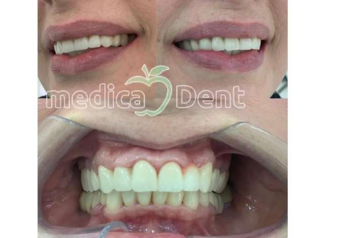 Klinike dentare ofron per ju sherbime profesionale per Implantologji, Drejtim dhembesh, Zbardhim Profesional etj.