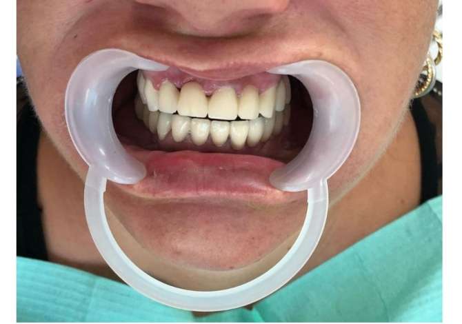 Klinike dentare ofron per ju sherbime profesionale per Implantologji, Drejtim dhembesh, Zbardhim Profesional etj.