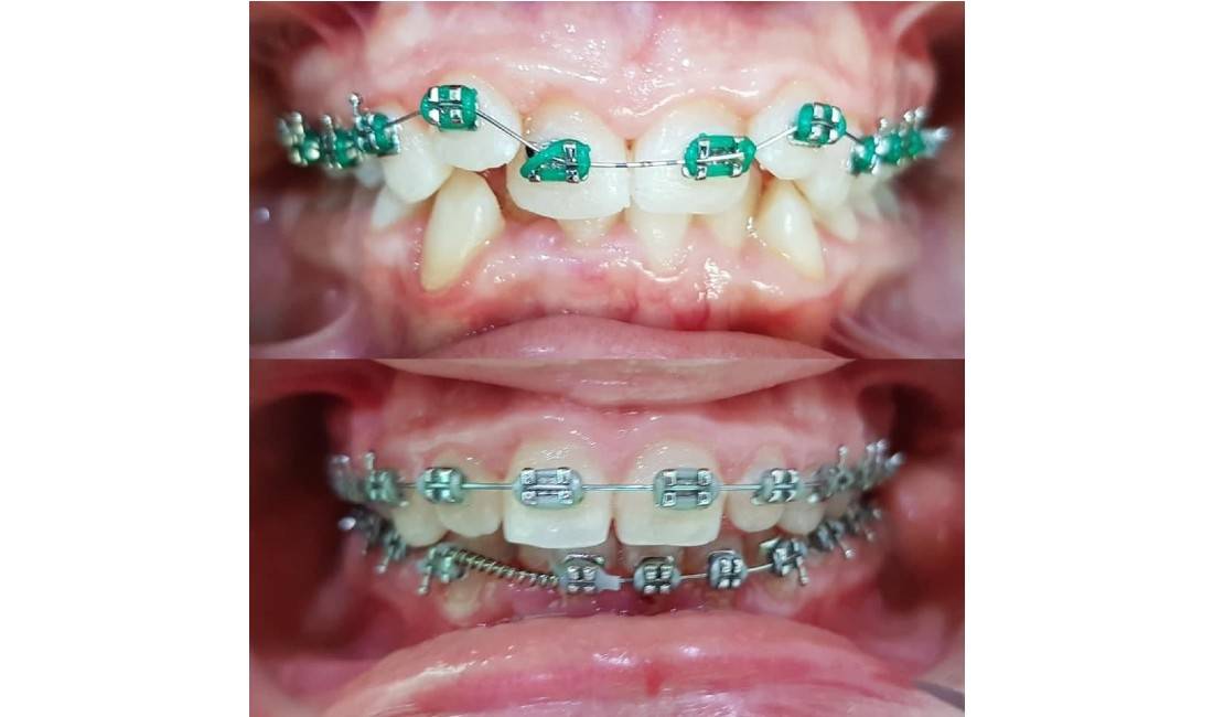 Klinike dentare ofron sherbime ne Implantologji, Ortodonci (aparate te levizshme, fikse, Maskerina transparente) etj.