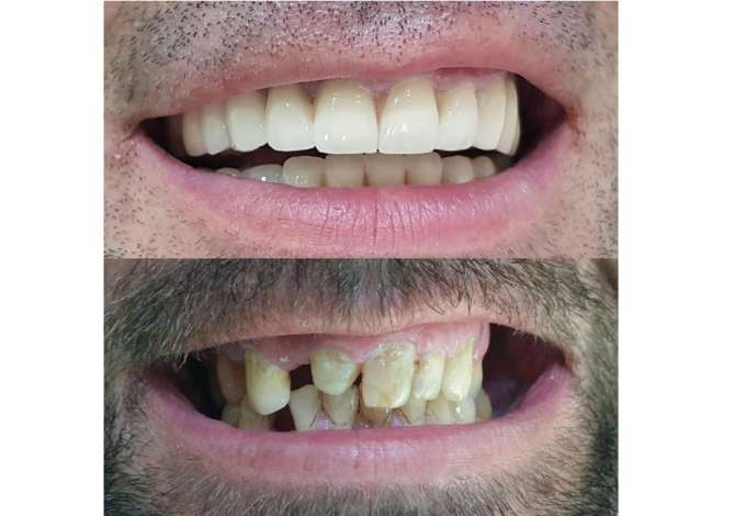Klinike dentare ofron sherbime ne Implantologji, Ortodonci (aparate te levizshme, fikse, Maskerina transparente) etj.