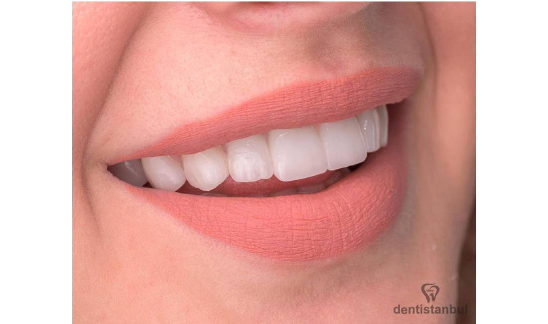 Klinik dentare ne Elbasan ofron sherbim te specializuar ne Stomatologji estetike, kirurigji orale, ortodonci, implantologji etj.