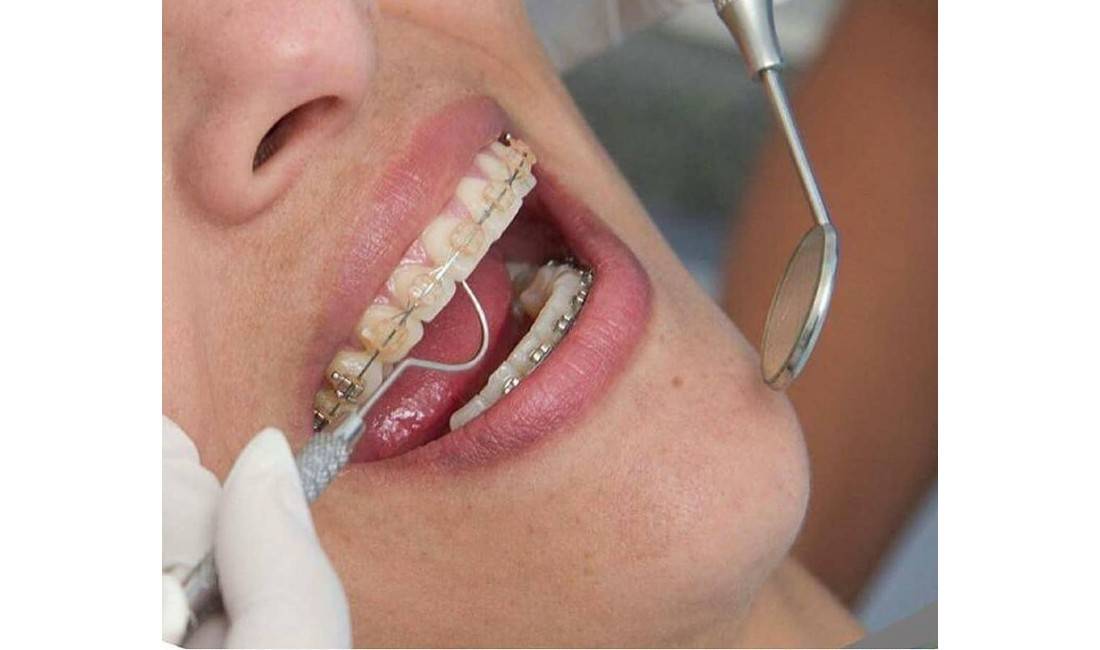 Klinika dentare ofron sherbim te specializuar ortodontik cilesor dhe garanton rezultatet e tij