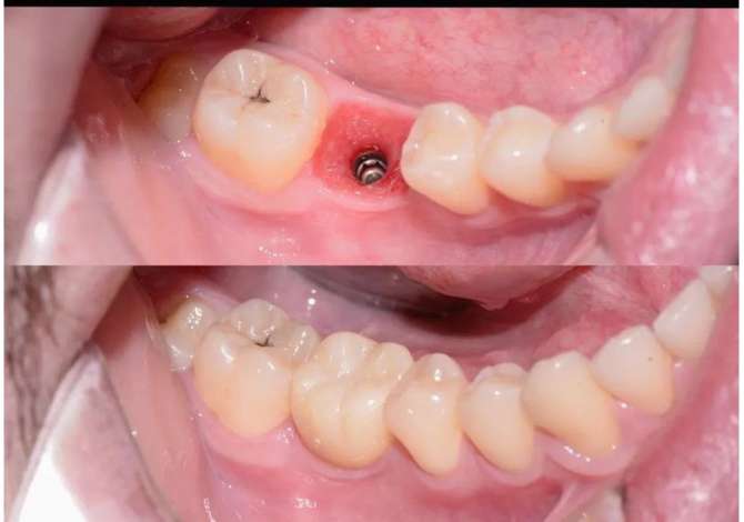 Klinike dentare ofron sherbime me profesionalitet te larte ne fushen e estetikes dentare,faciale,kirurgji orale-maksilo-faciale,implantologjise.