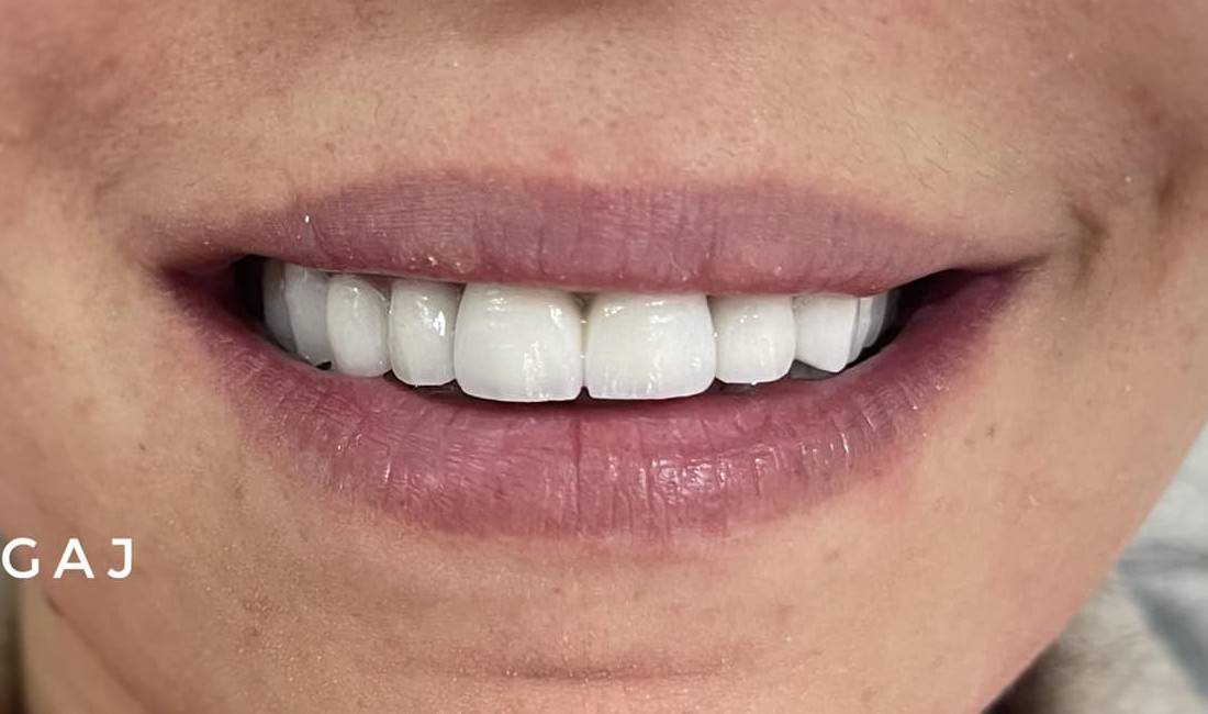 Klinike dentare ofron sherbime si :mbushje estetike,faseta,zbardhim,fluorizim,piercing,pastrim gurezash