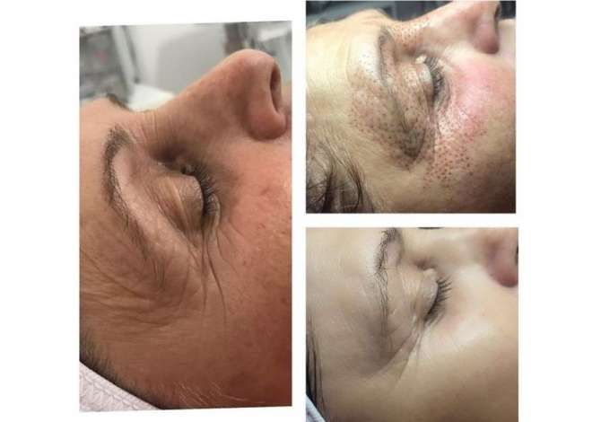 Klinike estetike ofron trajtime dermoestetike,dermapen,filler,botox,fibroblast,anticelulit,microblanding