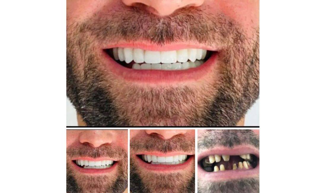 Klinika dentare Argjirodent ofron sherbime profesionale per implantologji, ortodonci fikse, drejtim dhembesh, zbardhim profesionale etj.