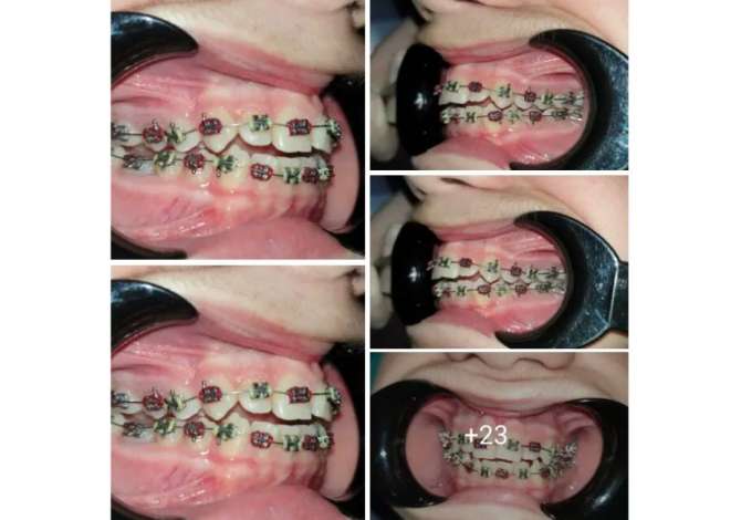 Klinika dentare Argjirodent ofron sherbime profesionale per implantologji, ortodonci fikse, drejtim dhembesh, zbardhim profesionale etj.