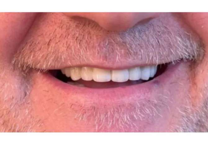 Klinika dentare Argjirodent ofron sherbime profesionale per implantologji, ortodonci fikse, drejtim dhembesh, zbardhim profesionale etj.