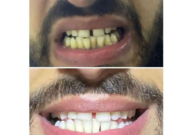 Klinika dentare Argjirodent ofron sherbime profesionale per implantologji, ortodonci fikse, drejtim dhembesh, zbardhim profesionale etj.