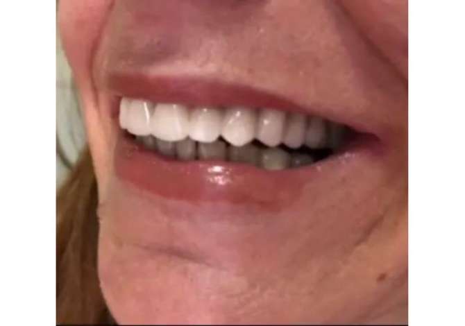 Klinika dentare Argjirodent ofron sherbime profesionale per implantologji, ortodonci fikse, drejtim dhembesh, zbardhim profesionale etj.