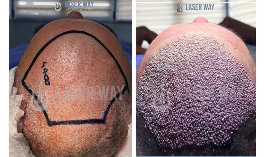  Klinika e specializuar per trajtimin definitiv te renies se flokut