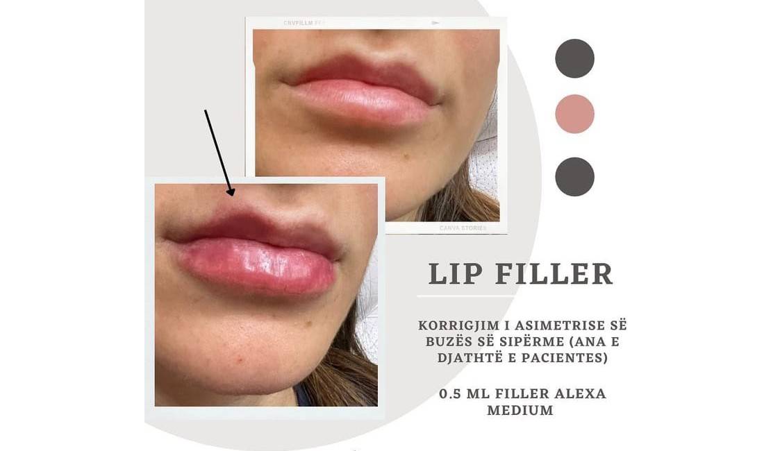 Klinke Dermo estektike ofron sherbime per filler, votox, lazer epilim,mesoterapi, fizioterapi, prophilo etj.